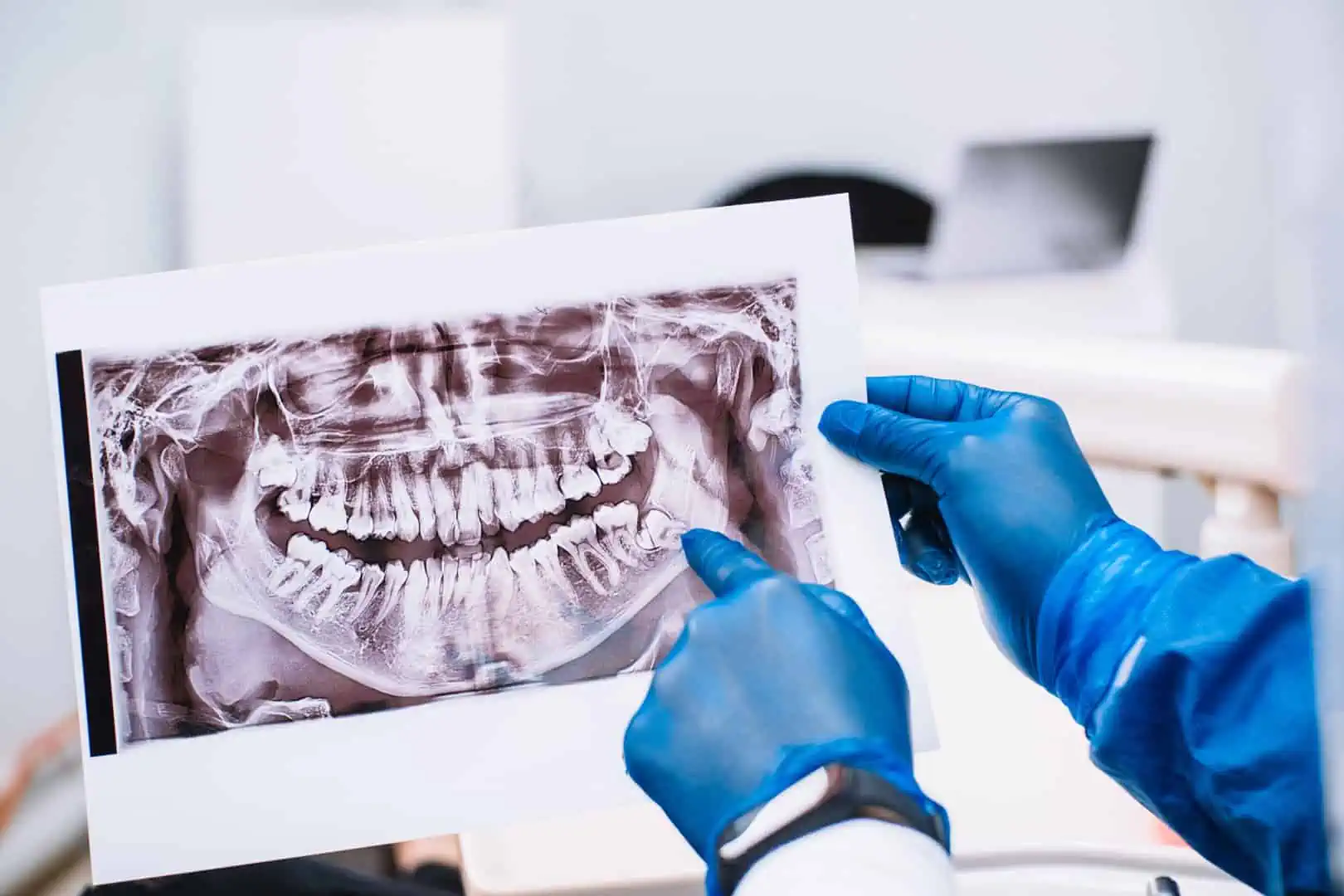 Wisdom teeth removal procedure at Joshua Dental in Pasadena
